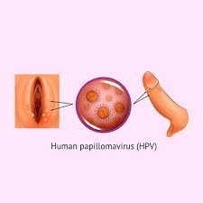 Image result for human papillomavirus symptoms