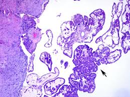 Graves' disease is the most common cause of overactive thyroid gland ( hyperthyroidism ). The Pathology Of Hyperthyroidism Abstract Europe Pmc