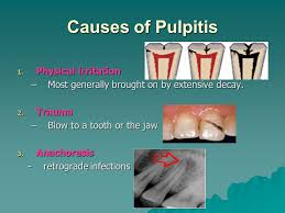 Image result for Pulpitis