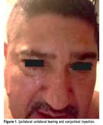 View of Hemicrania continua and Temporomandibular Disorders  Co-Presentation. Case Report