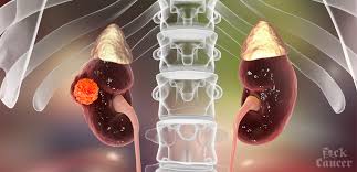You may be surprised to know that kidney cancer (also known as renal cancer) is in the top 10 most common cancers. Kidney Cancer Awareness Month