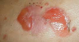 Image result for Pemphigus