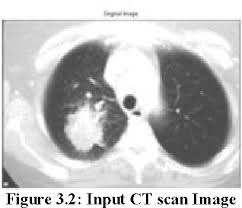Early detection of lung cancer (detection during the earlier stages). Pdf Detection Of Lung Cancer Stages On Ct Scan Images By Using Various Image Processing Techniques Semantic Scholar
