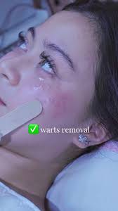 Warts Removal and Laser Treatments at Stelton Dermascience