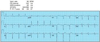 2020 Aha/Acc Guideline For The Diagnosis And Treatment Of Patients With  Hypertrophic Cardiomyopathy | Circulation