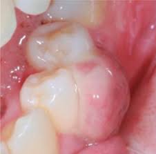 Image result for granuloma gum disease