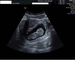 Around 20% of women say they experienced spotting during the first trimester of pregnancy and most of these women go on to have healthy babies, as do around half of all women who have any kind of bleeding during their pregnancies. Specialist Baby Scan Pain Bleeding Firstscan Window To The Womb