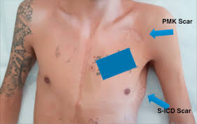During an arrhythmia, the heart can beat too fast, too slow, or with an irregular rhythm. Complex Transposition With The Risk Of Sudden Death While Awaiting Transplant Case Report By Berardo Sarubbi Md Phd Thoracic Key