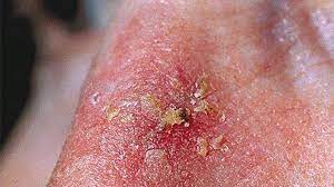 Flat, firm, pale or yellow areas, similar to a scar raised reddish patches that might be itchy small, pink or red, translucent, shiny, pearly bumps, which might have blue, brown, or black areas Skin Cancer Pictures And Facts What You Need To Know