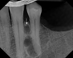 Multifocal Lateral Periodontal Cysts A Report Of 4 Cases And Review Of The Literature Oral Surgery Oral Medicine Oral Pathology Oral Radiology And Endodontics