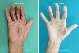 Here we tell you about. Scar Revision Elegant Plastic Surgical Centre In Ipoh Manjung Malaysia