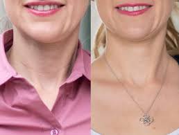 Strivectin Tl Advanced Tightening Neck Cream Plus Review In 2020 Neck Cream Neck Tightening Cream Strivectin
