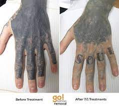 This Is One Of The More Dramatic Before And After Photos We Ve Shared Nearly 4 Years Ago This Client S Finger Tattoos Tattoo Removal Butterfly Tattoos On Arm