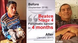 Therefore, the tnm system is not used as much for pancreatic cancer as it stage iia: Intervene Testimonial Stage 4 Pancreatic Cancer Youtube