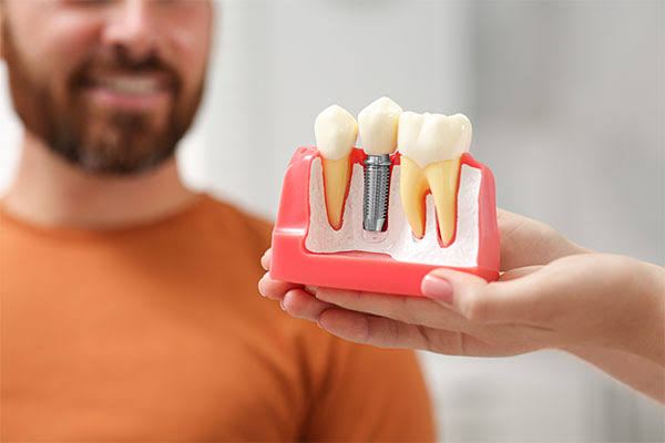 Dental Implants: Revolutionizing Smile Restoration - Life Dentistry