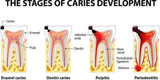Pdf | the chemical changes which occur during the process of carious destruction of enamel are complex due to a number of factors. Dental Caries Tooth Decay Dental Health Foundation