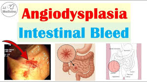 Image result for Small Intestinal Bleeding