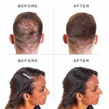 905 results for hair filler. 10 Best Hair Loss Concealer Reviews In 2020 Hold The Hairline