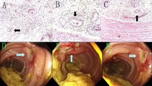 Image result for Small Intestinal Bleeding