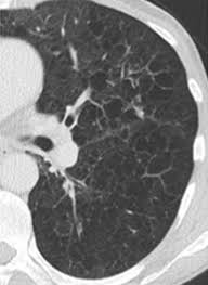 Emphysema involves gradual damage of lung tissue, specifically thinning and destruction of the alveoli or air sacs. Lung Cancers Associated With Cystic Airspaces Underrecognized Features Of Early Disease Radiographics