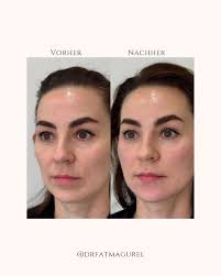 langfristiger Kollagenaufbau. Der Calciumhydroxylapatit-Filler strafft,  konturiert und regt die körpereigene Kollagenproduktion an. Ideal für  Kinnlinie, Wangen, Hals und Hände