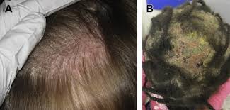 Image result for Tinea Capitis
