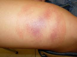 Nach einem zeckenstich sollten sie die hautstelle etwa sechs wochen lang im blick behalten. Zecken Und Borrelien Hautarztpraxis Geesthacht