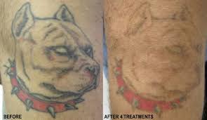Keloids usually begin to develop around three months after the original injury, and can continue to grow for weeks or even months. Straight No Chaser Tattoo Removal Jeffrey Sterling Md
