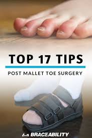 Pin On Foot Toe Injuries Fractures Sprains Arch Pain Plantar Fasciitis Nerve Injuries And Drop Foot