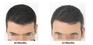 Considerable loss of weight than expected. Growth Of Hair After Fue Maral Hair