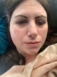 The staples came out today, but I have another complication. The incision 