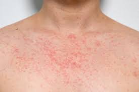 Image result for sweat rash on back