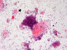 Maybe you would like to learn more about one of these? Fun With Microbiology What S Buggin You Bacterial Vaginosis