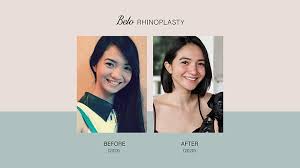 We bring you the same digital imaging technology that surgeons use to visualize plastic surgery results — all in a super. Angel Dei Shows Off Her New Nose In A Twitter Post Belo Medical Group