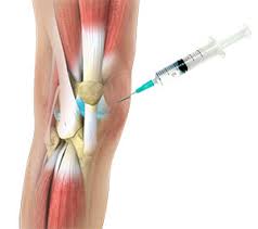Image result for Knee Injection