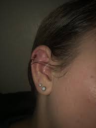 These Bleeding Blisters Irritation Bumps Keep Popping Up On My Upper Helix Piercing About To Retire It To Let It Heal Any Last Things I Should Try It S Almost 5 Months Old Piercing