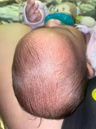 Image result for white scabs on the head in children