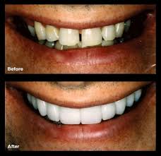 Unfortunately, we can't prevent teeth gaps or change our biology. Fix Gap Spaces Teeth Bands Oppenheim Signature Smiles