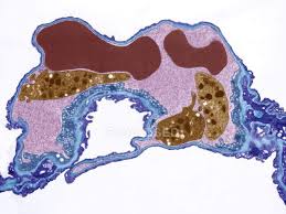 Transmission electron microscope images of red blood cells. Lung Tissue Coloured Transmission Electron Micrograph Tem Of A Pulmonary Capillary Containing Two Red Blood Cells