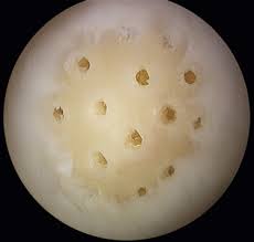 Cartilage Surgery In The Adult Musculoskeletal Key