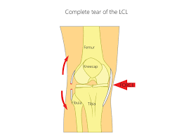 Physical therapy will likely be required, but rehabilitation and recovery can happen within 3 months without surgical intervention. Lateral Collateral Ligament Lcl Tears Upswing Health
