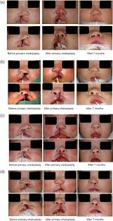 Photographs of typical cases where the patients were in either the Hotz...  | Download Scientific Diagram