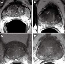 Continue shopping your session is about to timeout due to inactivity. Multi Parametric Mr Imaging Of Transition Zone Prostate Cancer Imaging Features Detection And Staging