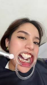 Back to metal braces!😂💕 Thanks Doc @Janelyn Dakila of @Oradent Dental  Clinic Candelaria!!🥰 Ang galing galing nila gumawa huhu☺️🥰 #theadeluna  #fyp #oradentdentalcliniccandelaria