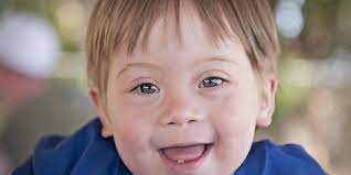 متلازمة داون هو الجينوم الأمراض. Ù…ØªÙ„Ø§Ø²Ù…Ø© Ø¯Ø§ÙˆÙ† Down Syndrome ÙƒÙ„ Ù…Ø§ ØªØ±ÙŠØ¯ Ù…Ø¹Ø±ÙØªÙ‡ Ø¹Ù†Ù‡Ø§
