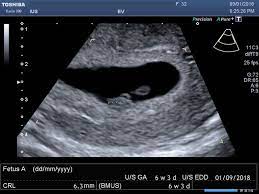 If your first ultrasound is earlier than seven weeks, the baby is often so small that it's hard to see with a traditional abdominal ultrasound. 6 Week Pregnancy Scan 6 Week Ultrasound 6 Week Scan 6 Week Scan Photo International Ultrasound Services