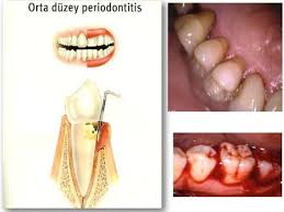 Diş lekesinin doğal tedavisi misvak kullanmaktan geçer. Dis Eti Iltihabi Neden Olur Dr Tuncay Akdoganli
