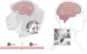 Image result for Thalamic Stimulation
