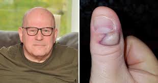 It is the body's most extreme response to an infection. Grandfather Left Fighting For His Life After Developing Sepsis From Biting His Finger Nails Social Junkie