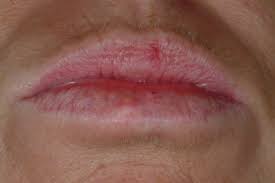 Image result for Lip Cancer